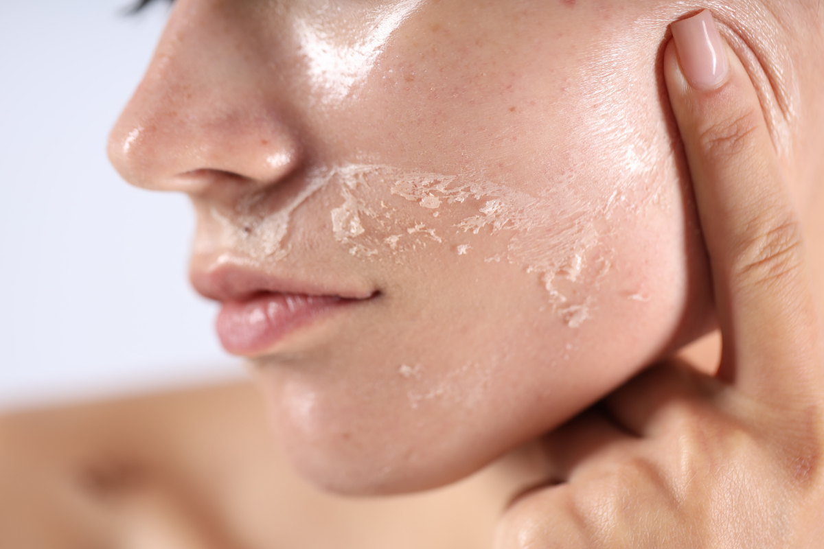 Peau sèche qui pèle — différence peau sèche et peau déshydratée Éléa Cosmétiques